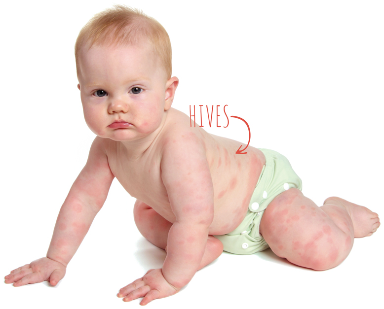 Baby crawling with visible hives on skin